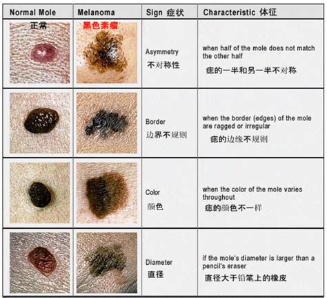 全身都是痣|你身上的痣会癌变吗？医生分析了100多颗黑痣，快来对照下！